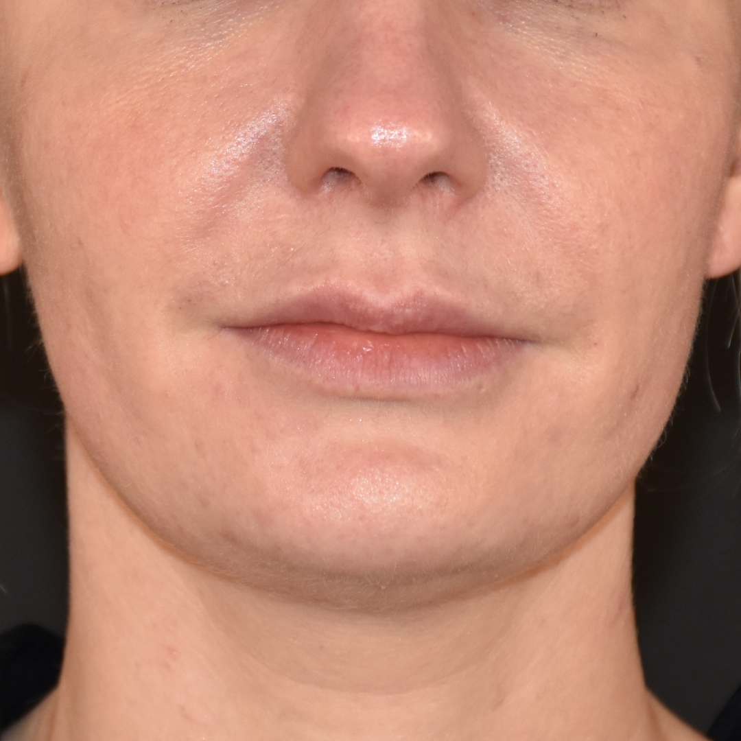 Case--2605 | After Ultherapy 2