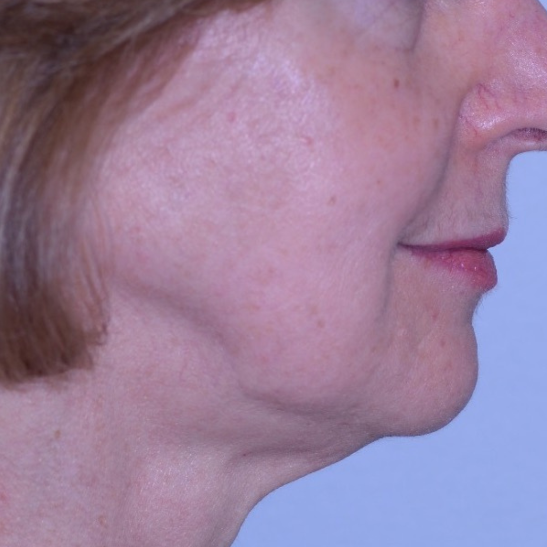 Case--4557 | After Medspa