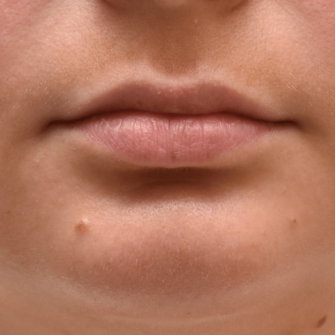 Case--8065 | After Facial Fillers 2