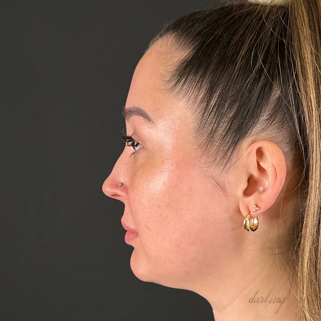 Case--6431 | Before Facial Fillers 2