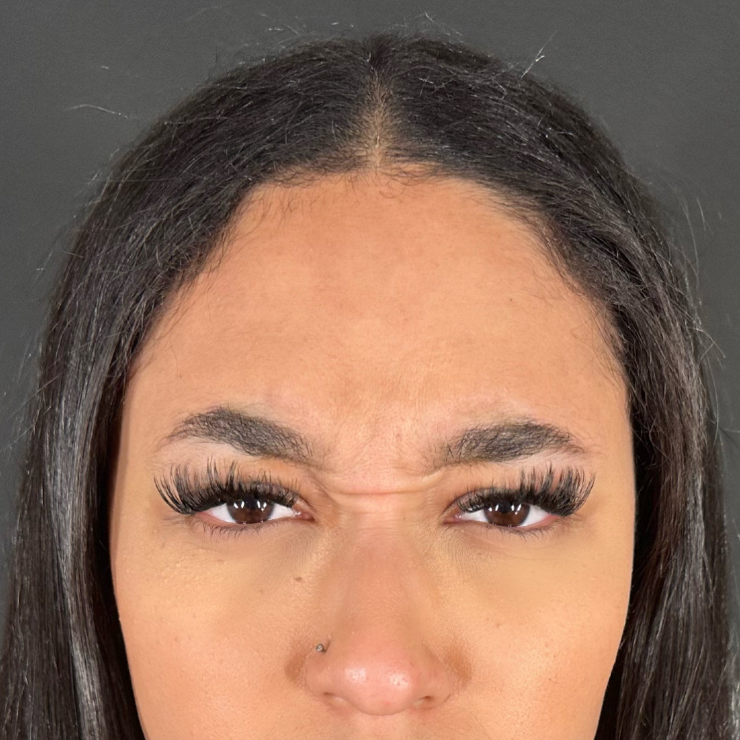 Case--5478 | Before Medspa