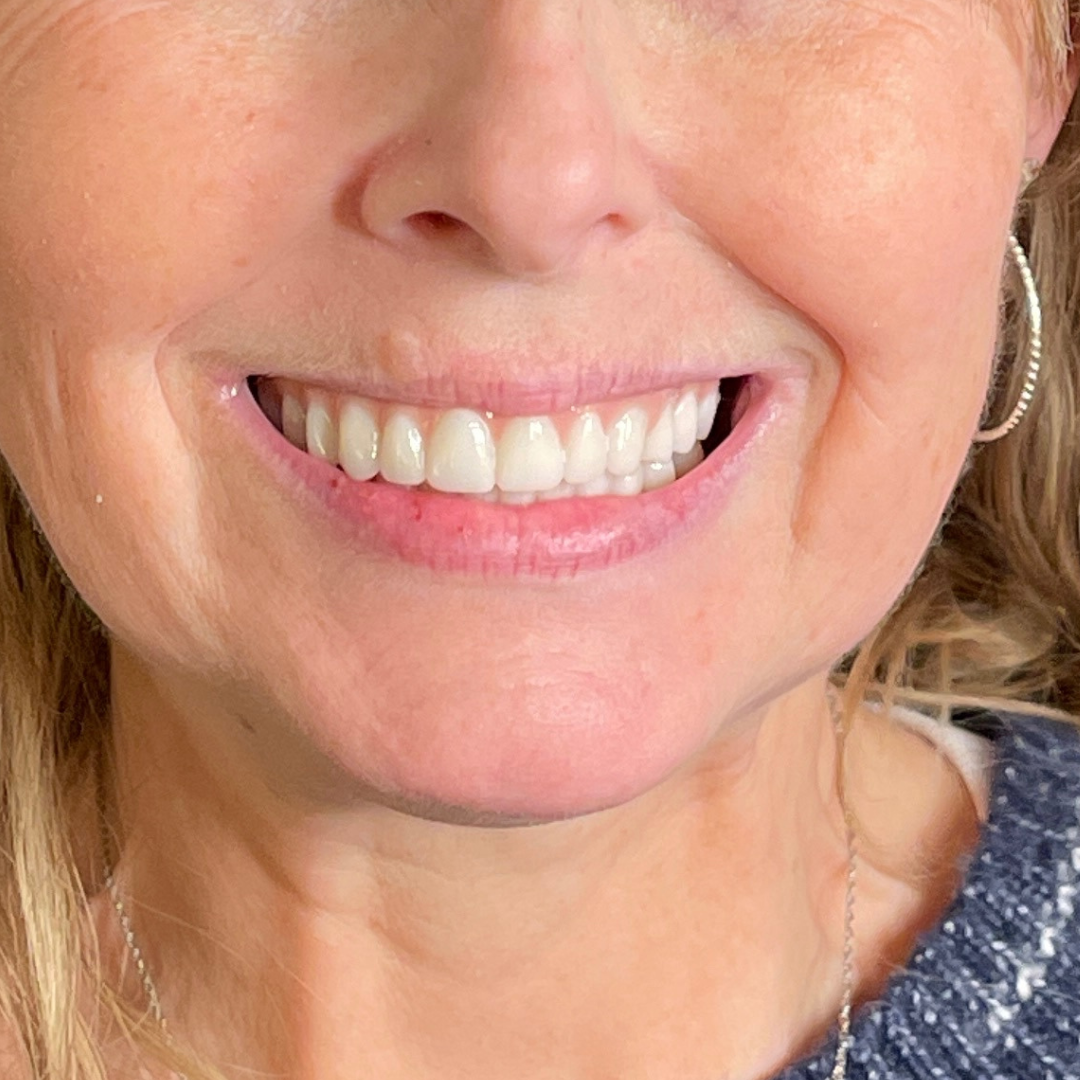 Case--4622 | Before Facial Fillers 2