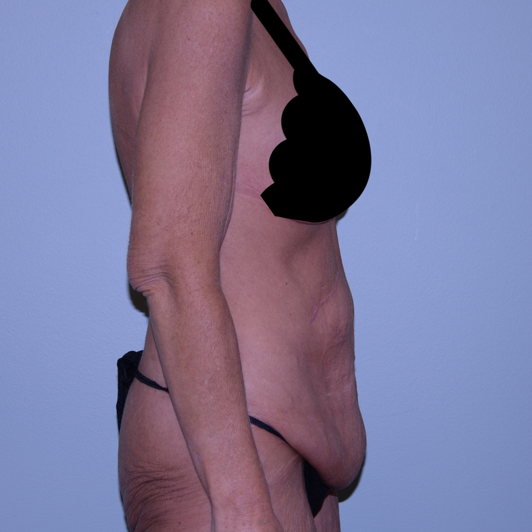 Case--5404 | Before Massive Weight Loss 4