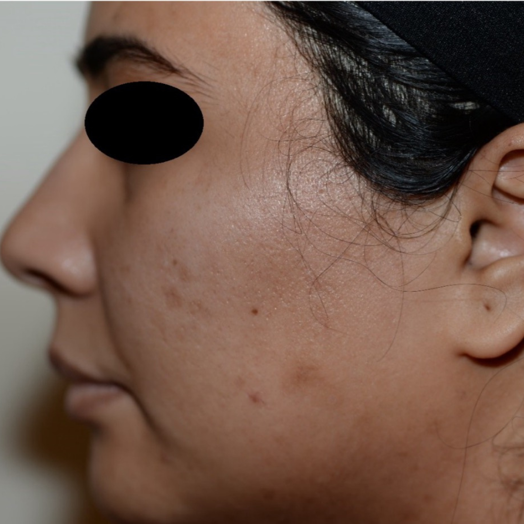 Case--2119 | Before Medical Grade Skincare 3