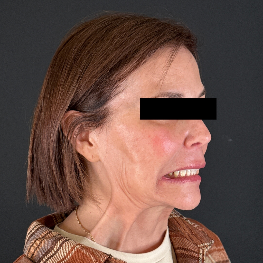 Case--6842 | Before Neurotoxins 3