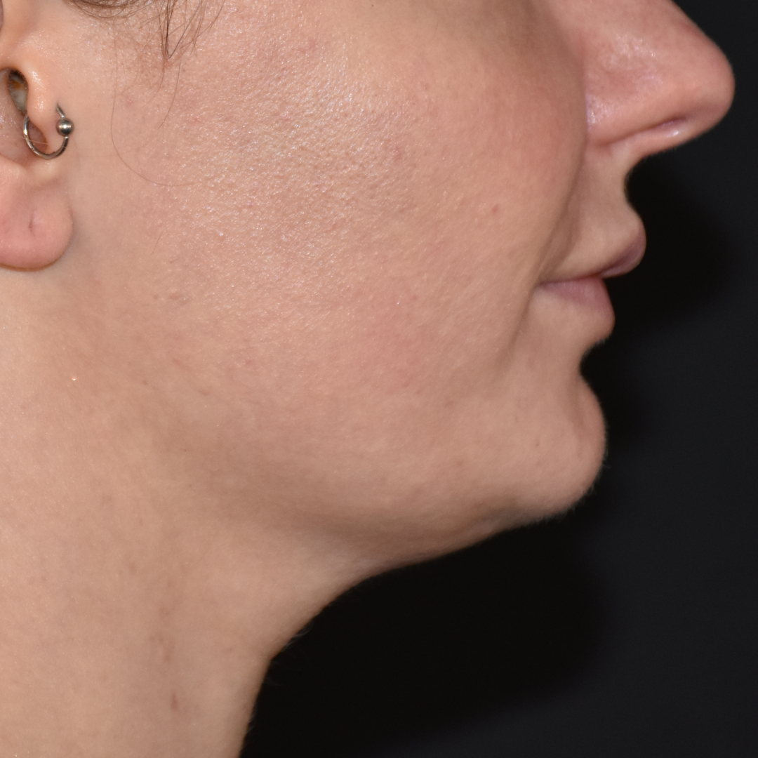 Case--2605 | Before Medspa