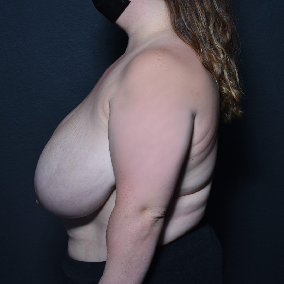 Case--3655 | Before Breast Reduction 2