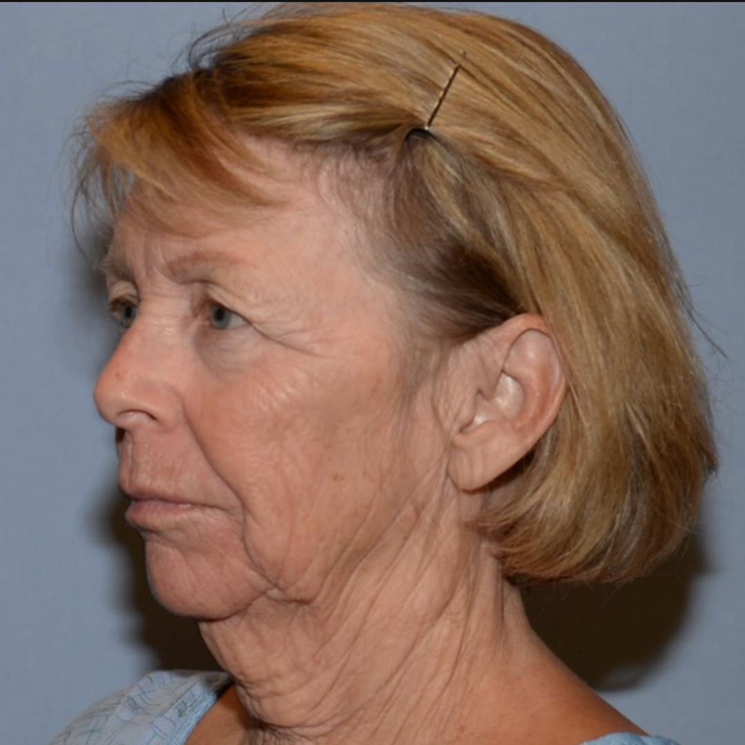 Case--2128 | Before IPL & Laser Treatments 2