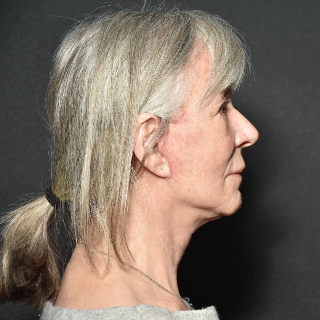 Case--5450 | After Facelift and Neck Lift 4
