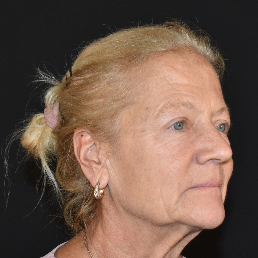 Case--4846 | Before Facial Fillers 2