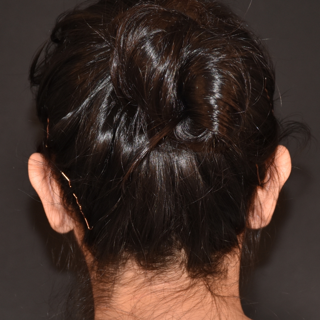 Case--1984 | Before Ear Pinning 2