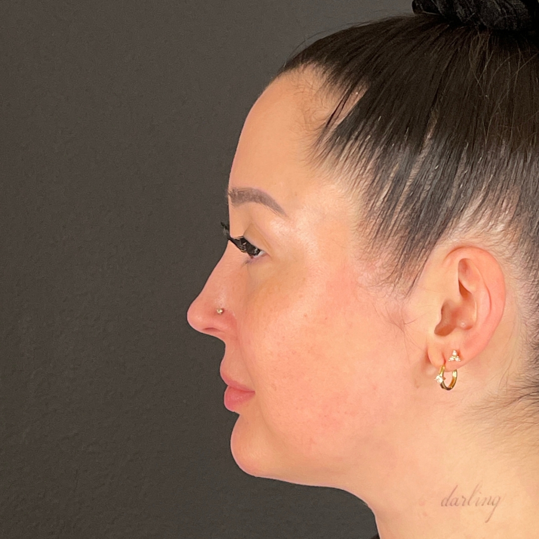 Case--6431 | After Facial Fillers 2