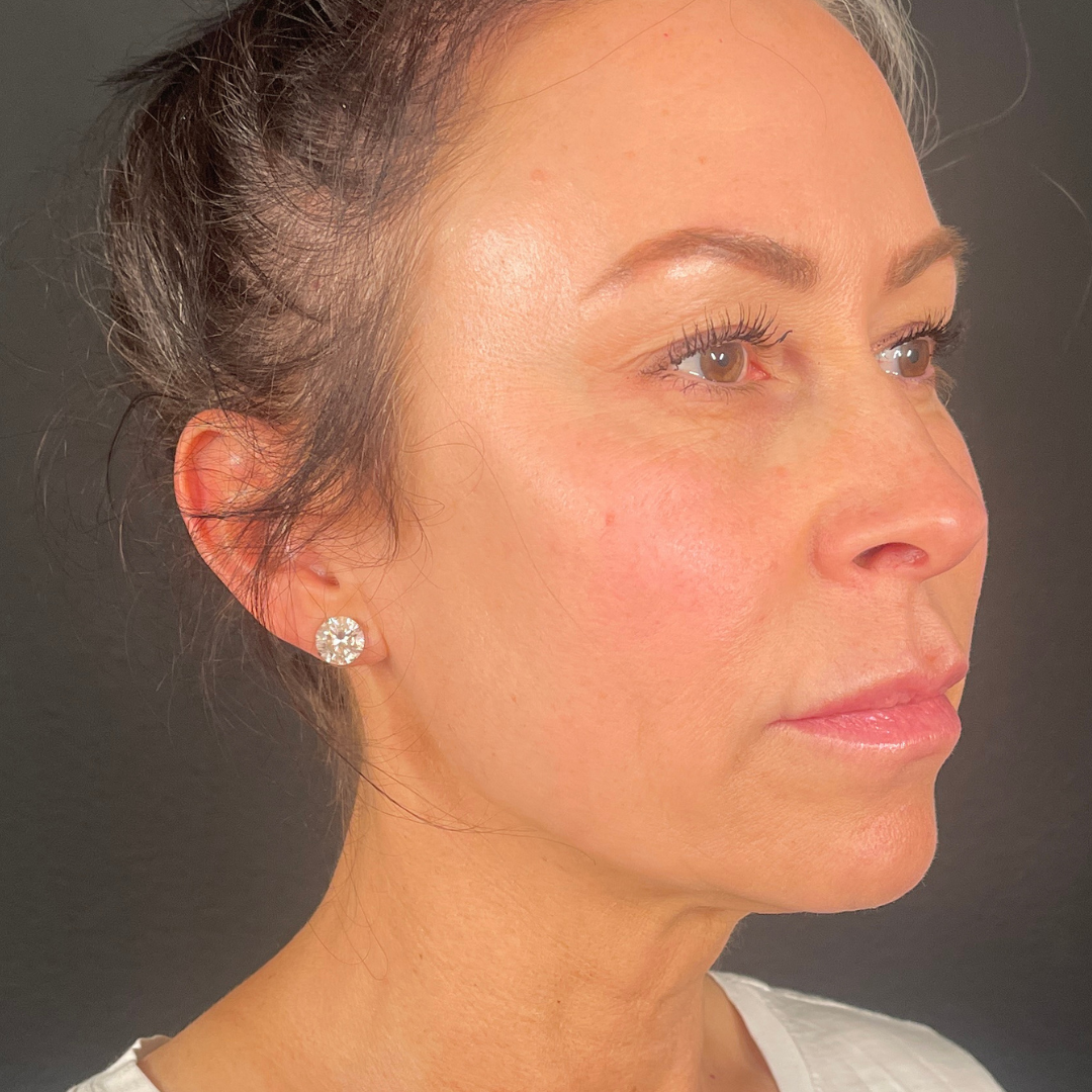 Case--7901 | After PDO Threads 4