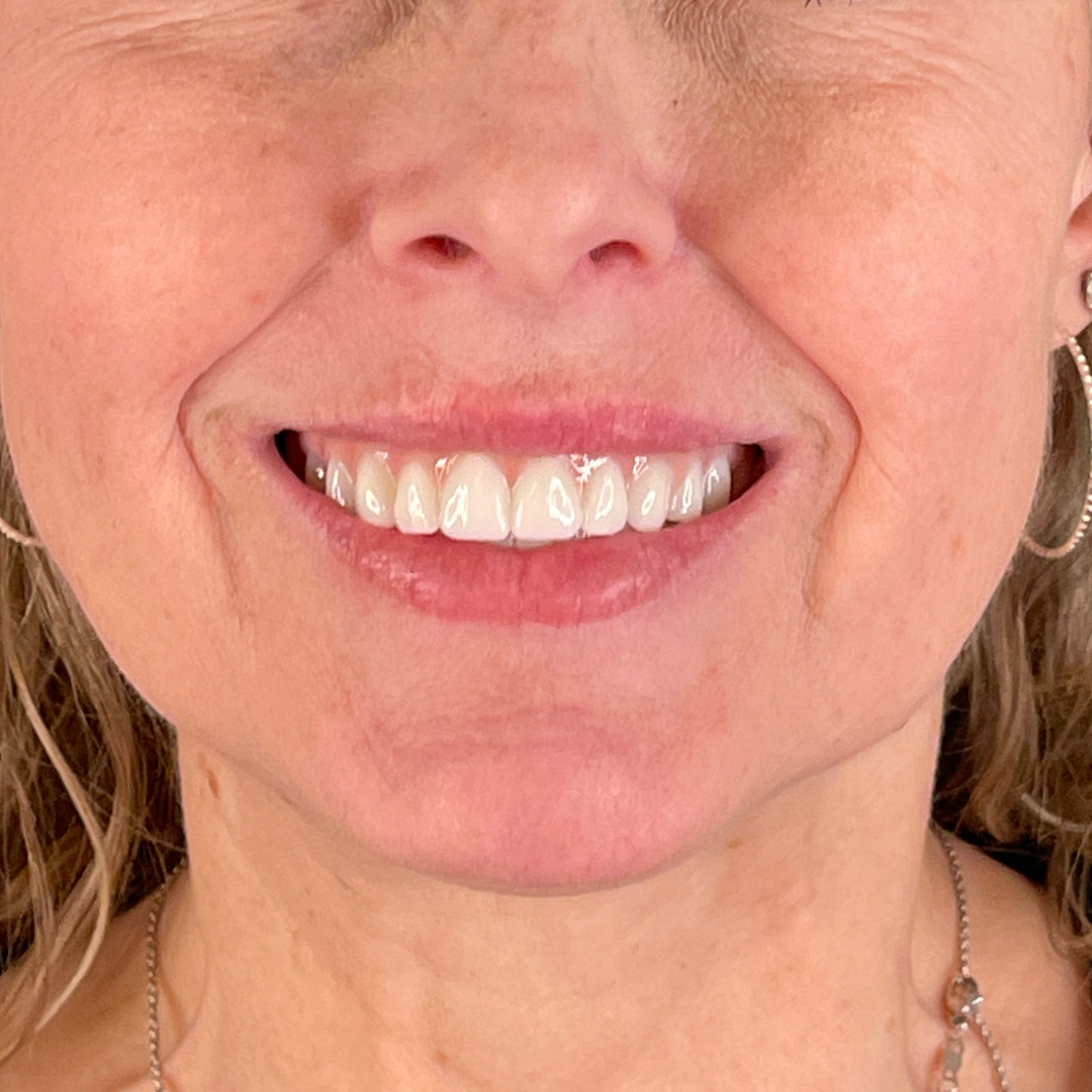 Case--4622 | After Facial Fillers 2