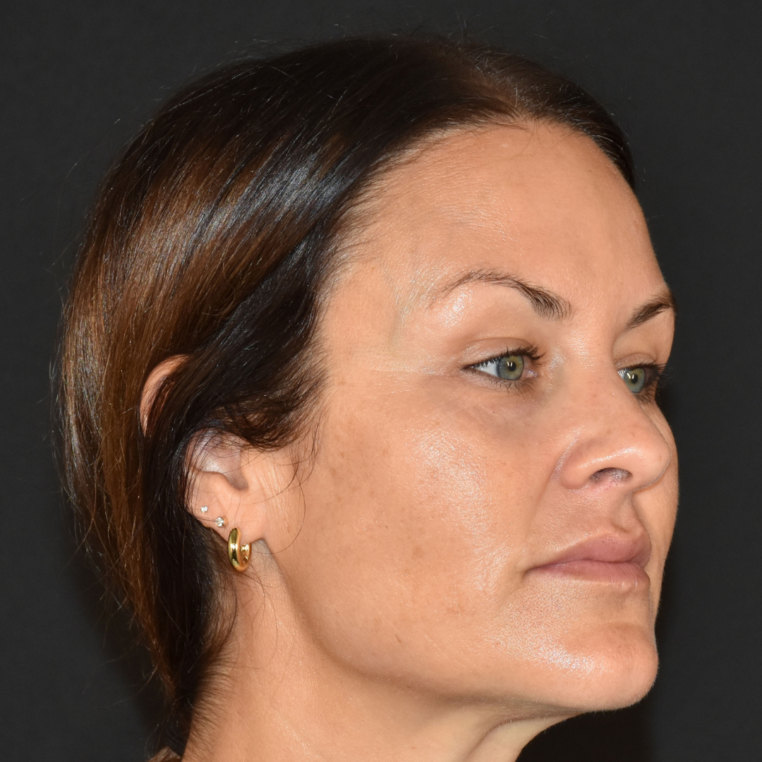 Case--3321 | After Facial Fillers 2