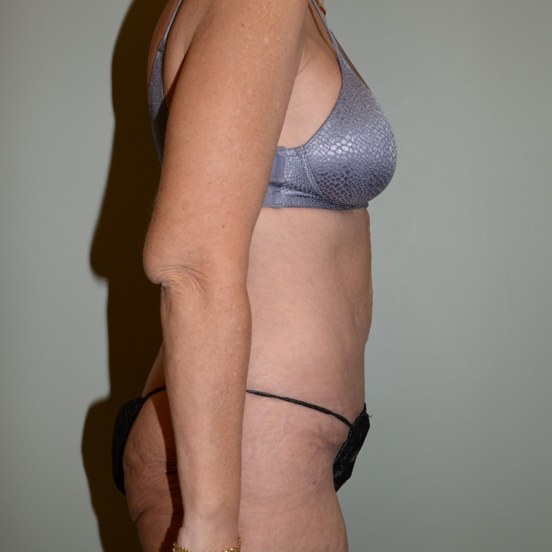 Case--5404 | After Massive Weight Loss 4