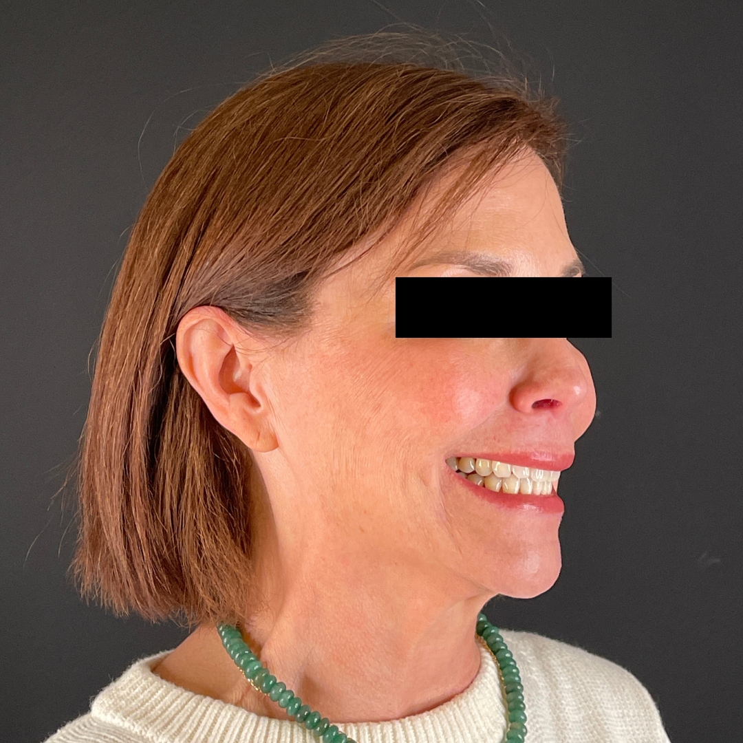 Case--6842 | After Neurotoxins 3