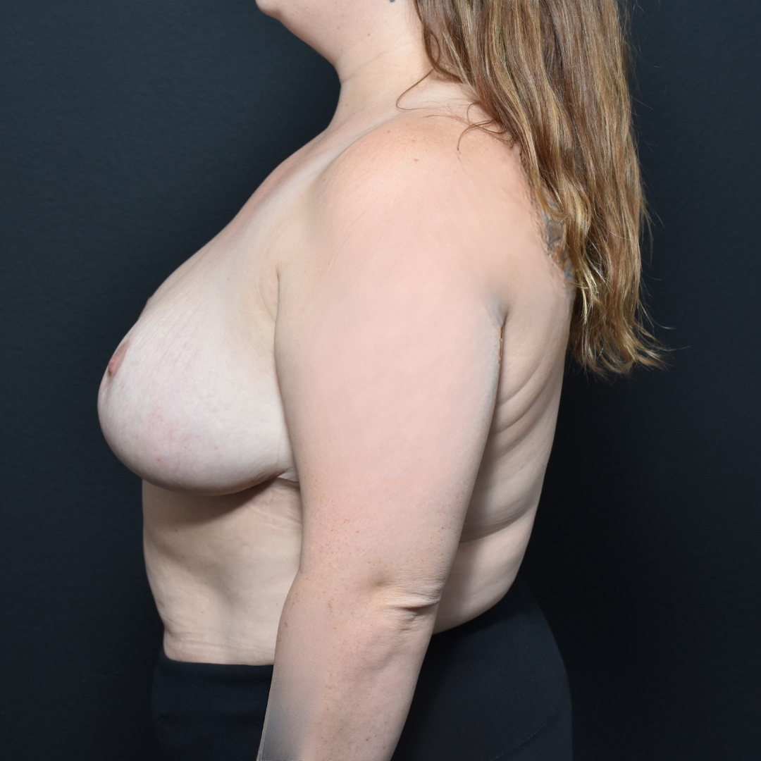 Case--3655 | After Breast Reduction 2