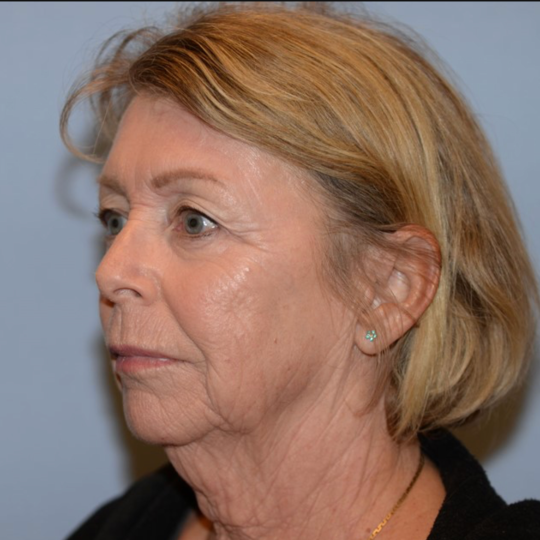 Case--2128 | After IPL & Laser Treatments 2