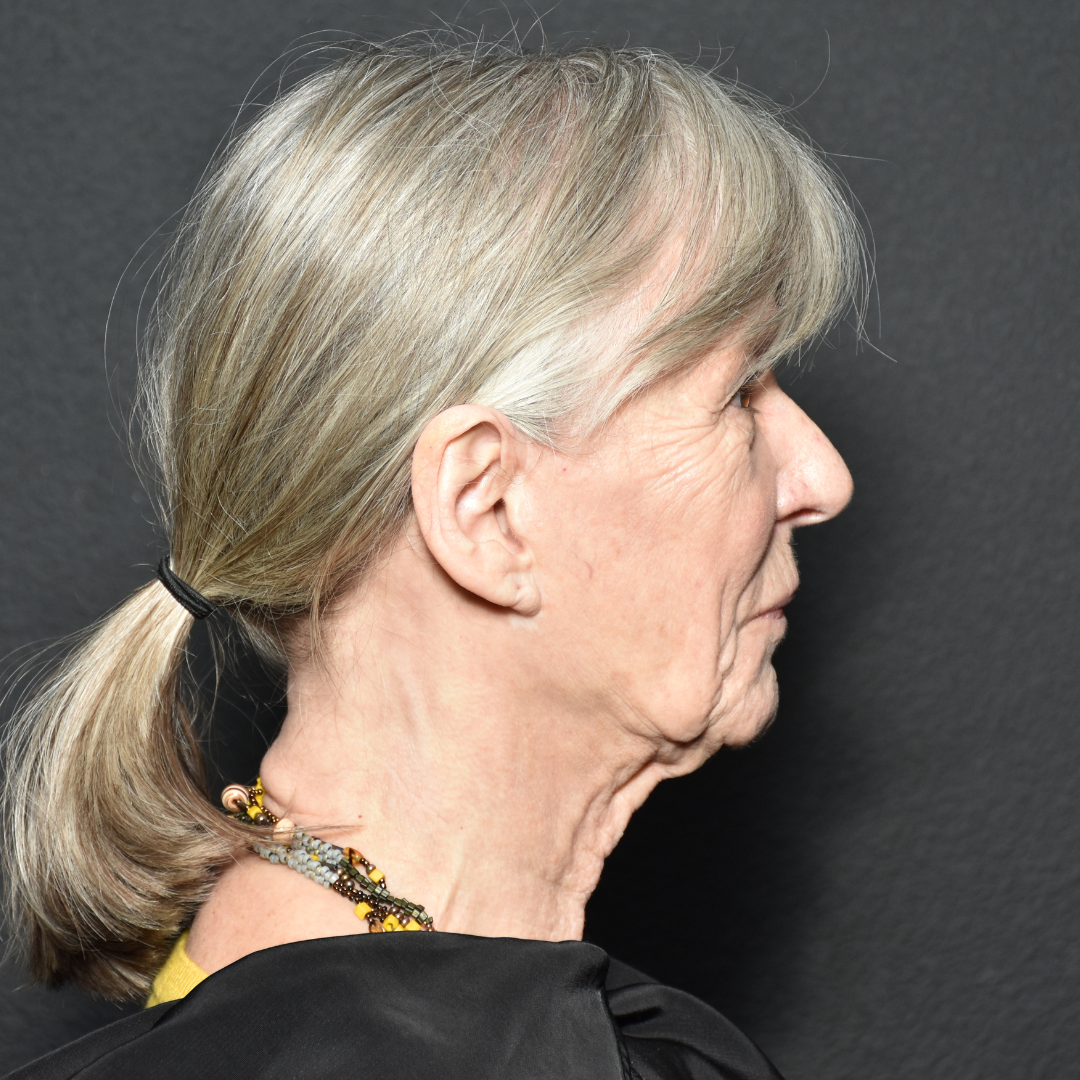 Case--5450 | Before Facelift and Neck Lift 4