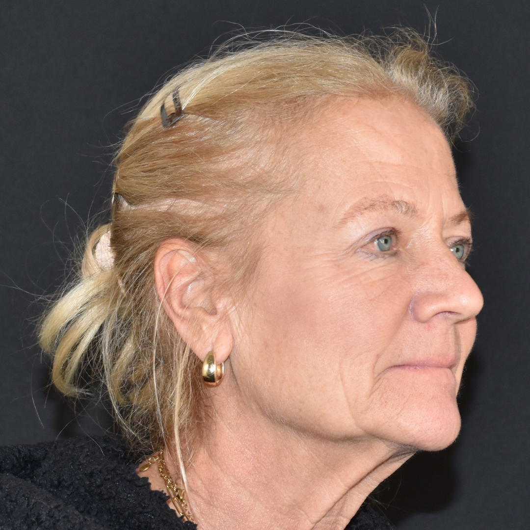 Case--4846 | After Facial Fillers 2