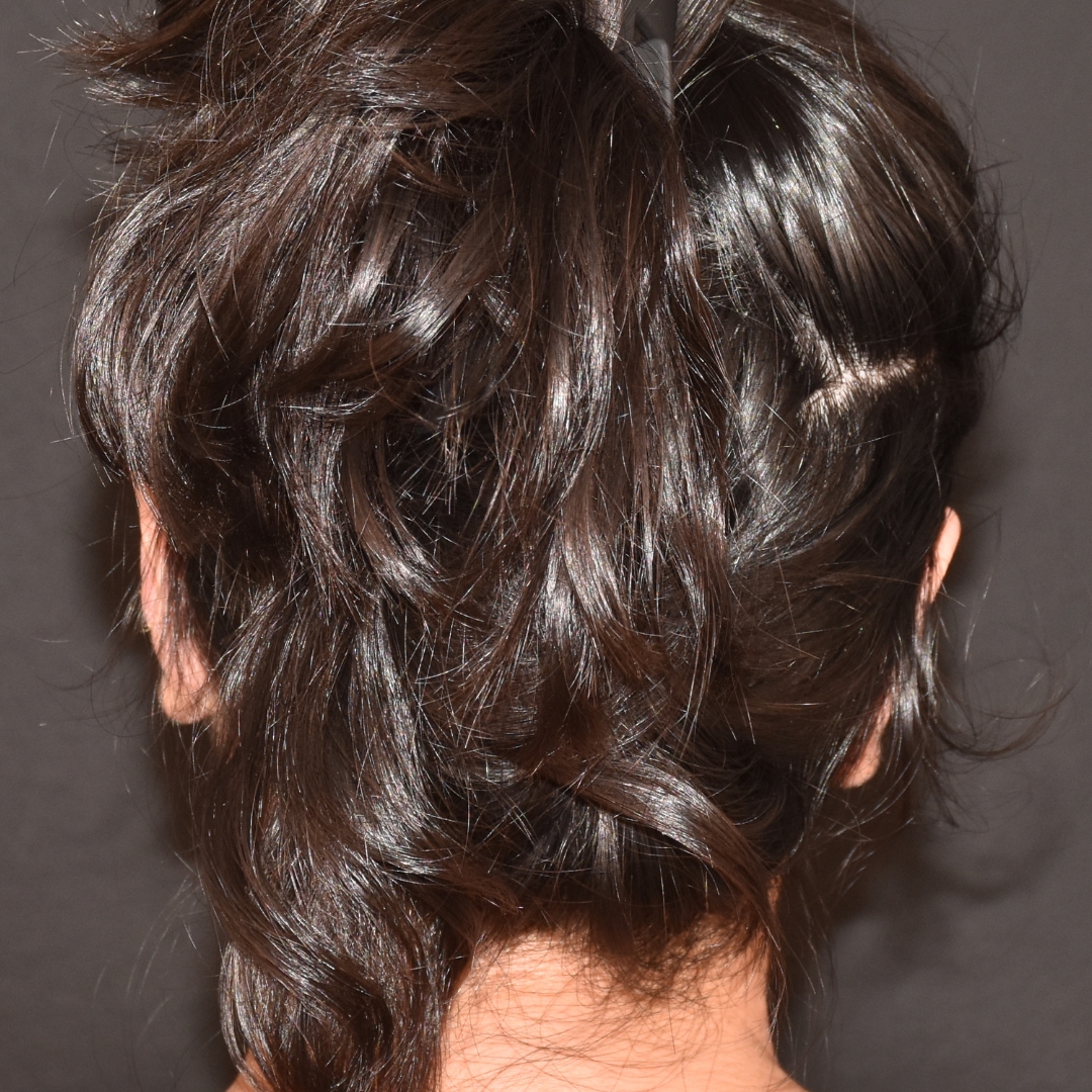 Case--1984 | After Ear Pinning 2