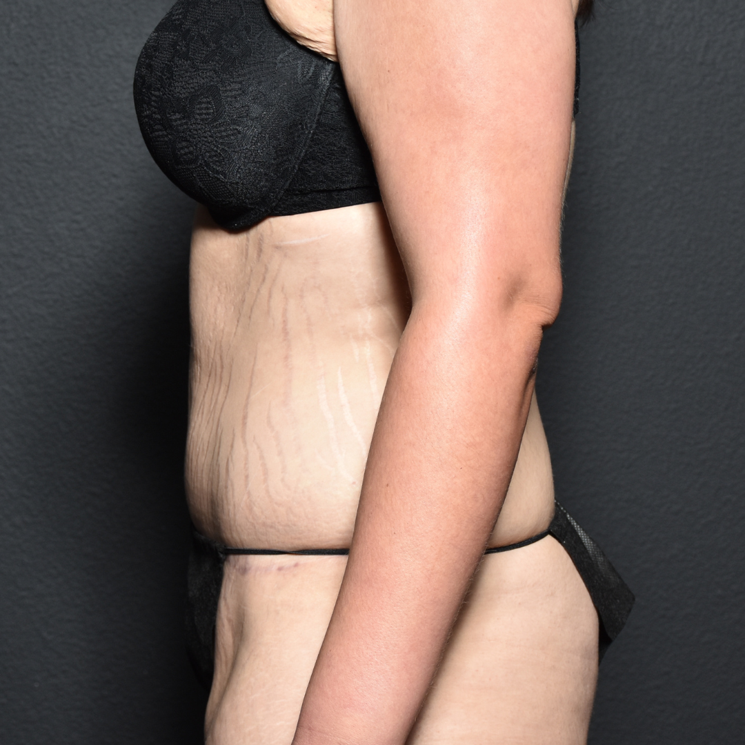 Case--7427 | After Tummy Tuck 2