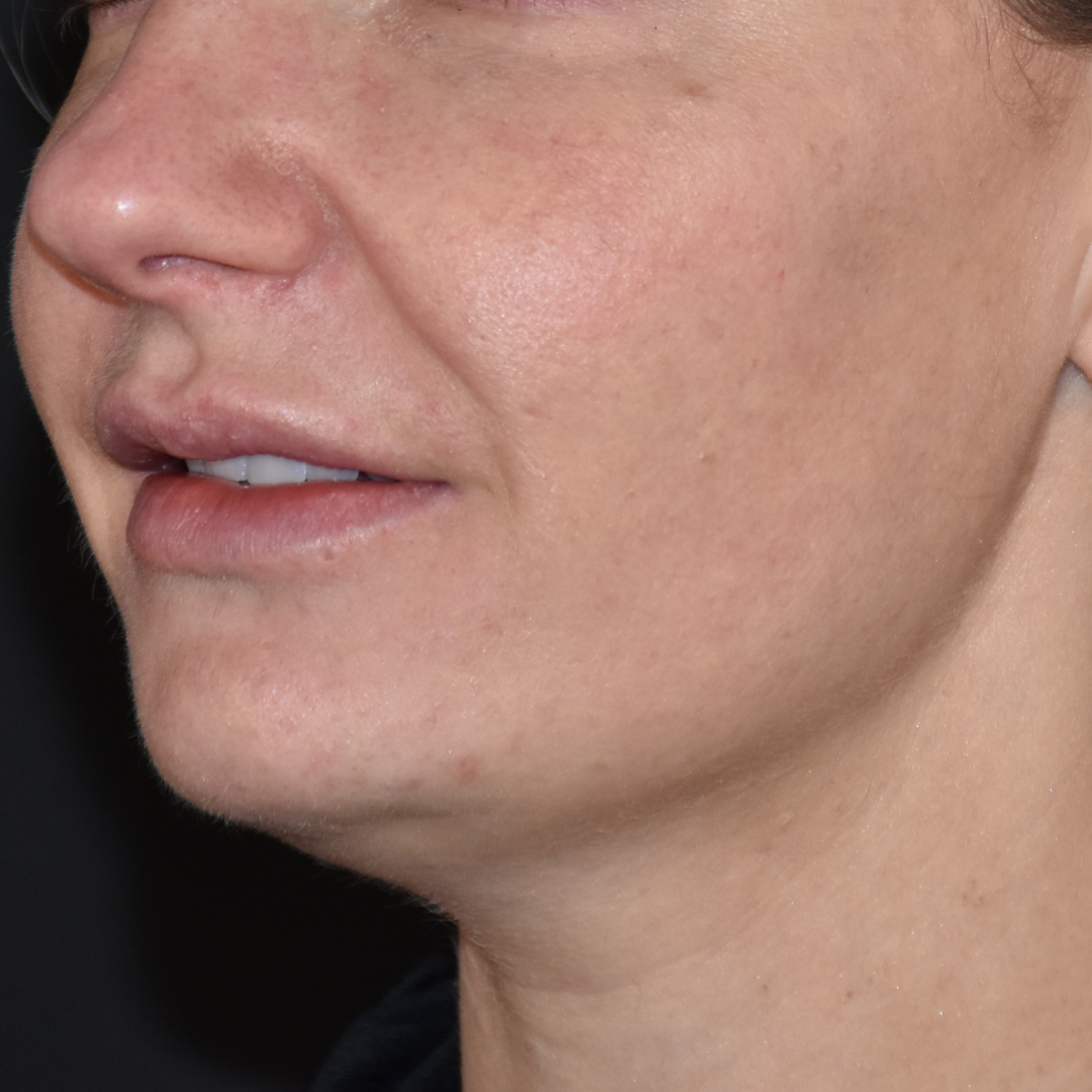 Case--2605 | Before Ultherapy 3