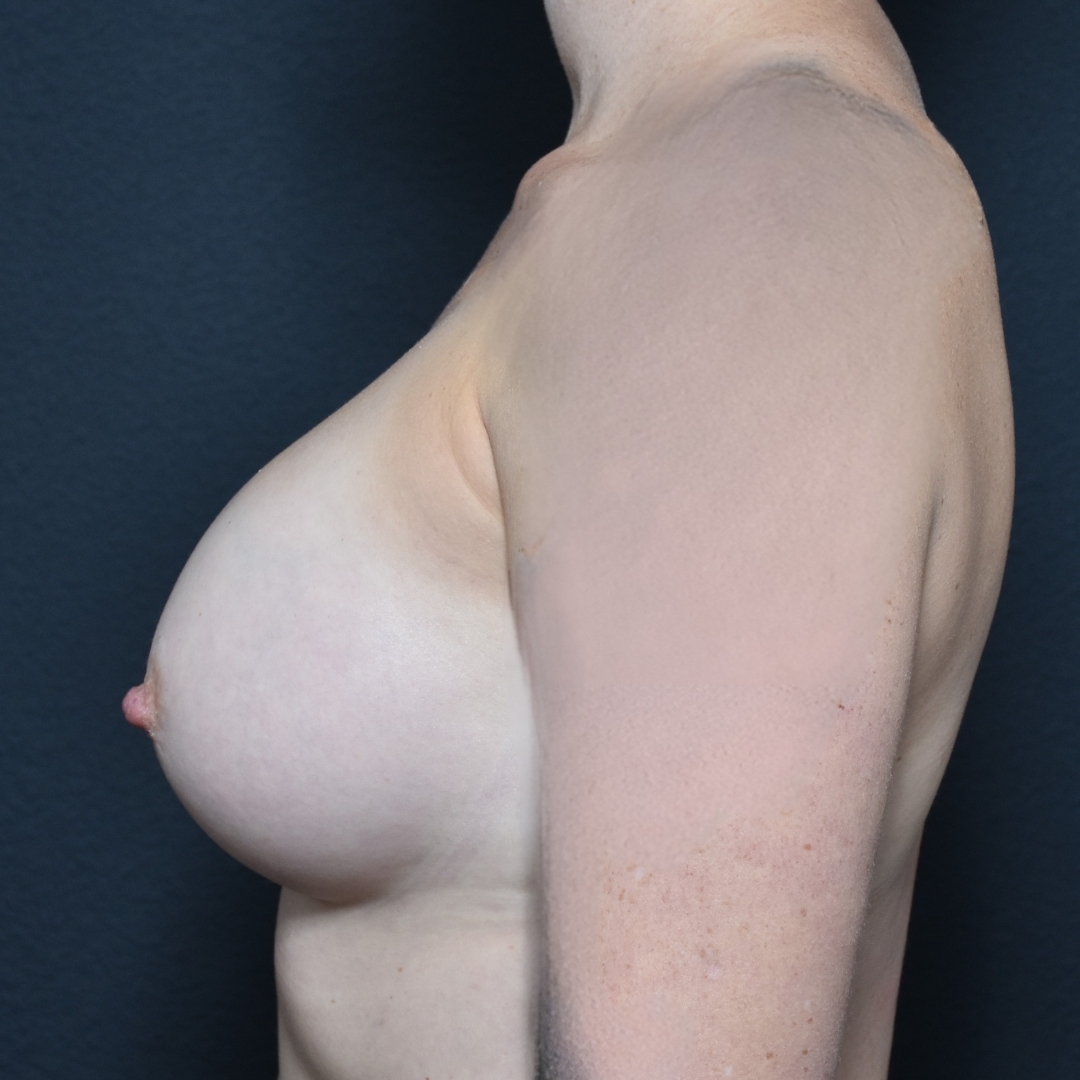 Case--1581 | After Breast Augmentation 3