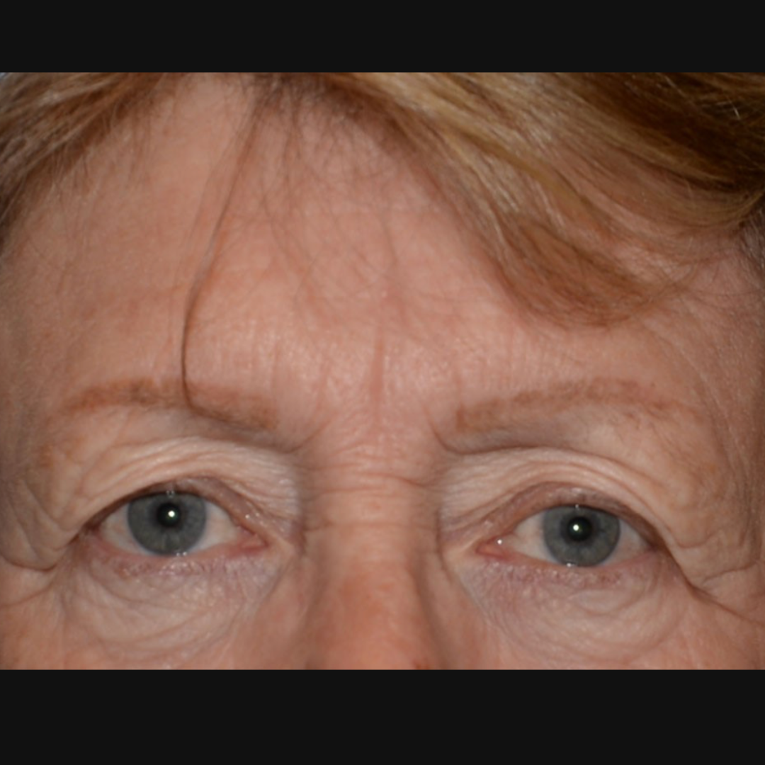 Case--2128 | Before IPL & Laser Treatments 3