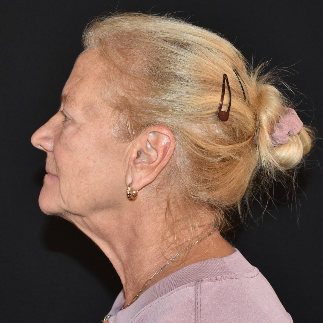 Case--4846 | Before Facial Fillers 3