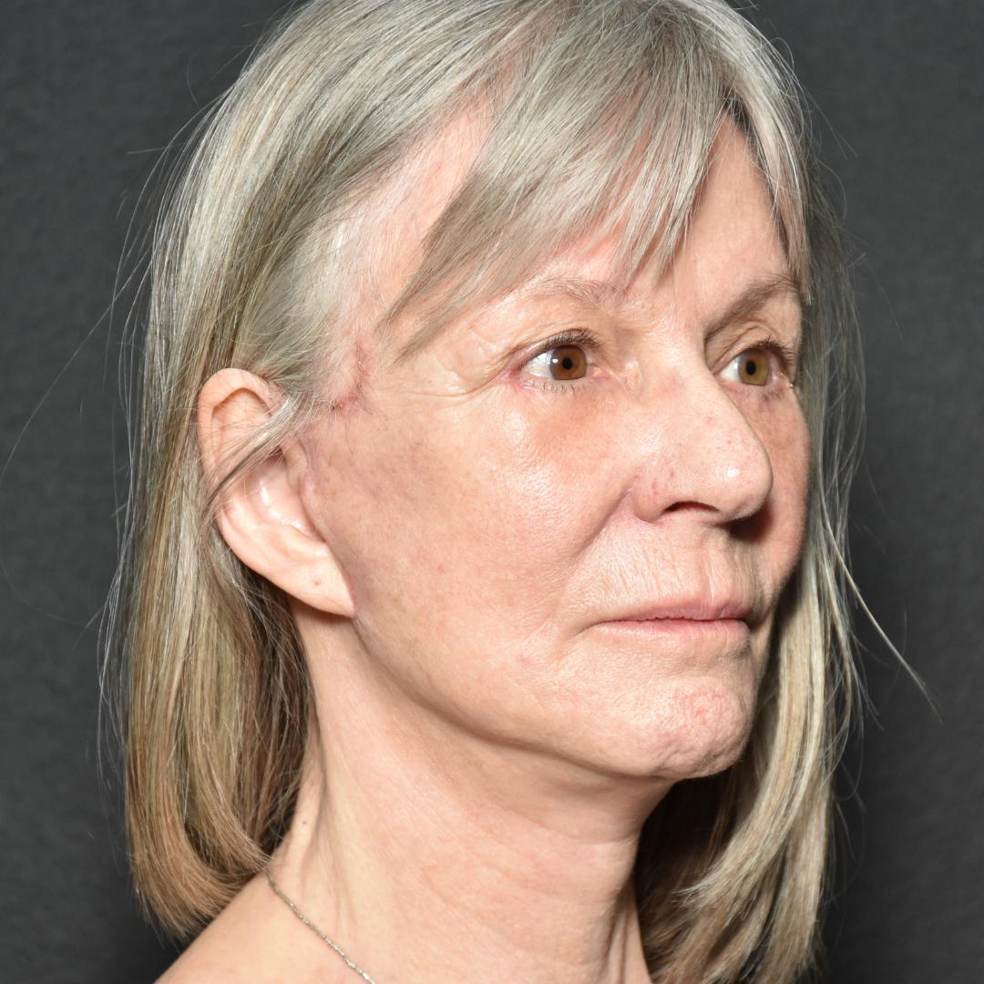 Case--5450 | After Facelift and Neck Lift 3