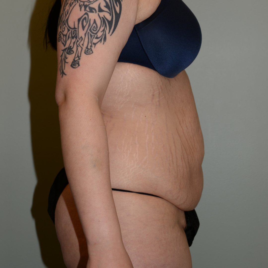 Case--7427 | Before Tummy Tuck 3