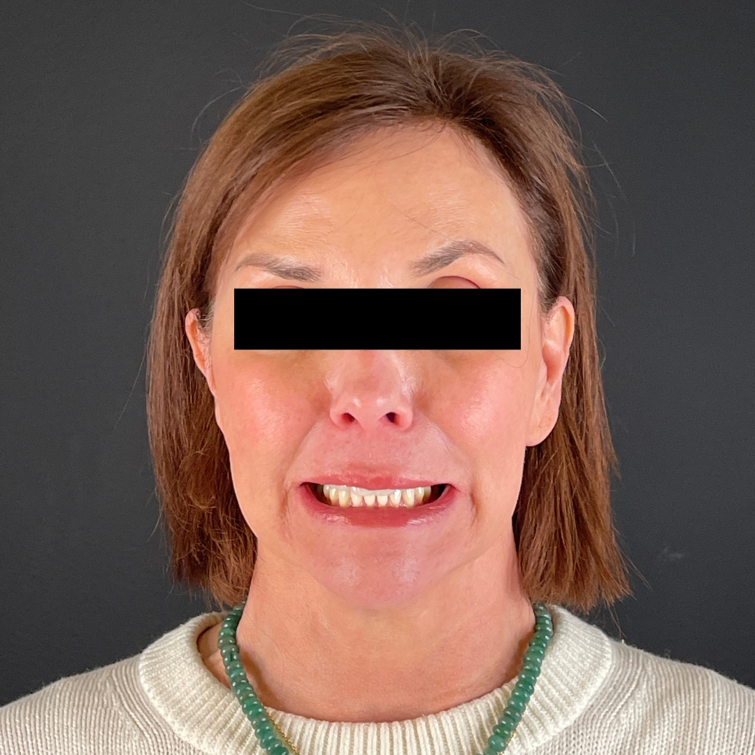 Case--6842 | After Neurotoxins 2