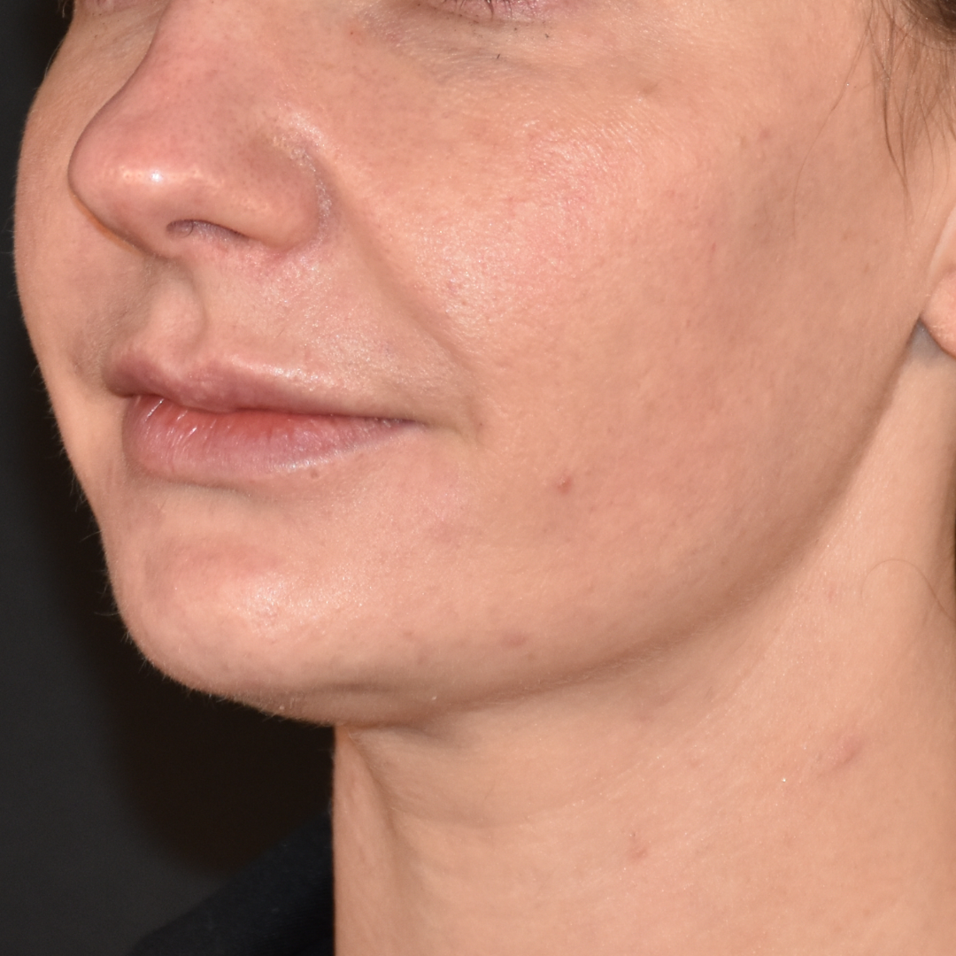 Case--2605 | After Ultherapy 3