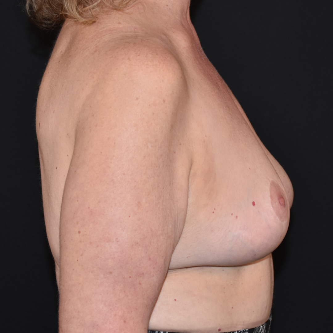 Case--6556 | After Breast Lift 3