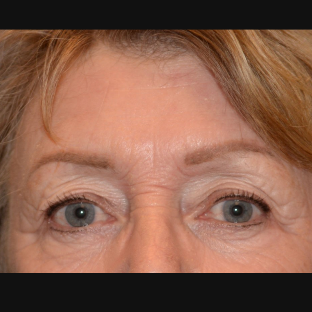 Case--2128 | After IPL & Laser Treatments 3