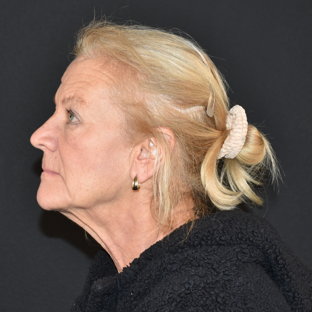 Case--4846 | After Facial Fillers 3