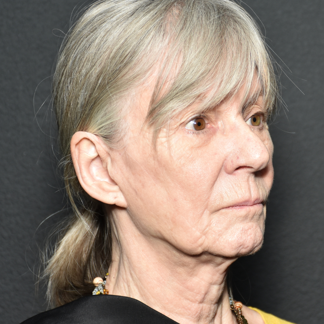 Case--5450 | Before Facelift and Neck Lift 3