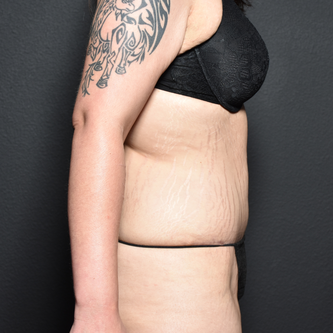 Case--7427 | After Tummy Tuck 3