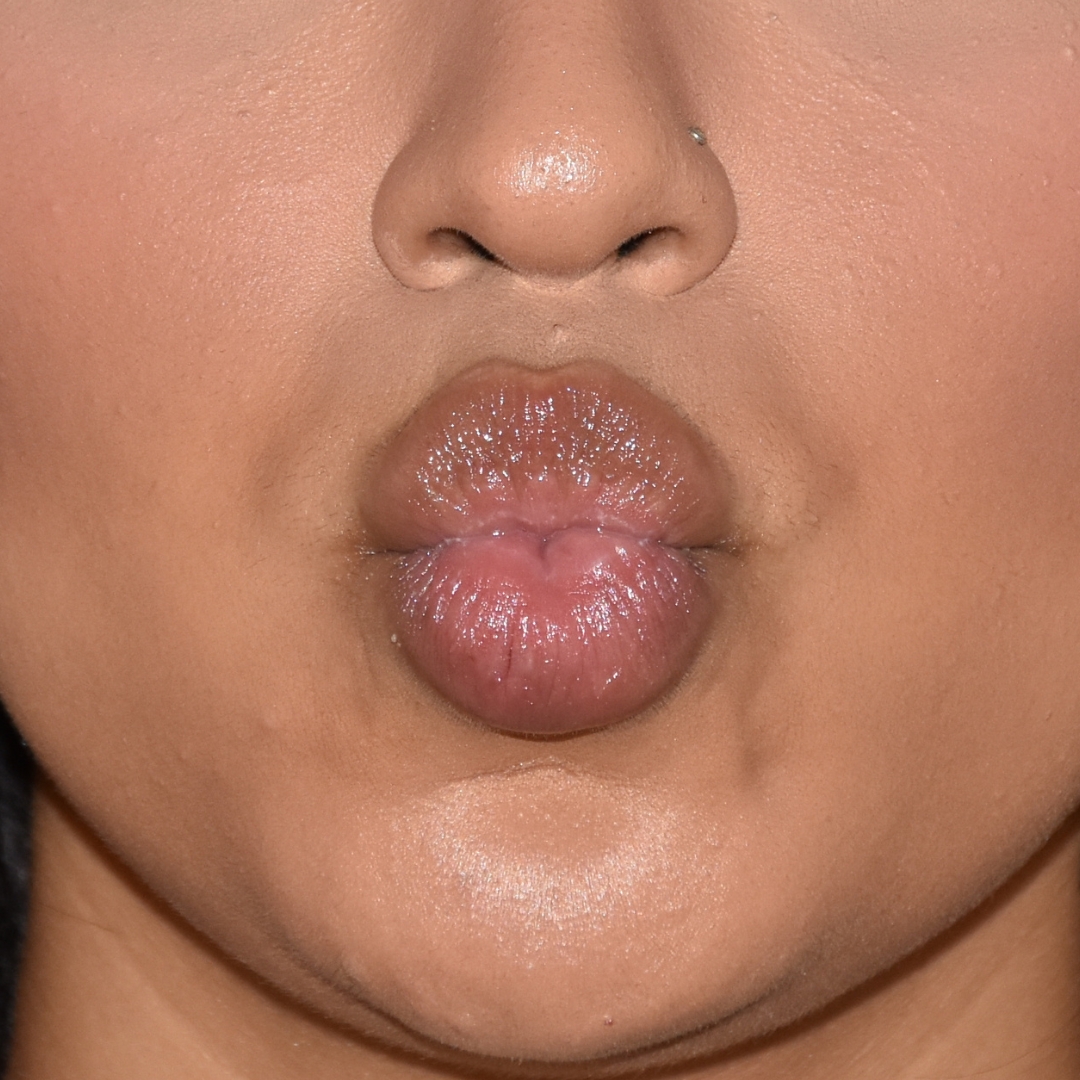 Case--9574 | Before Facial Fillers