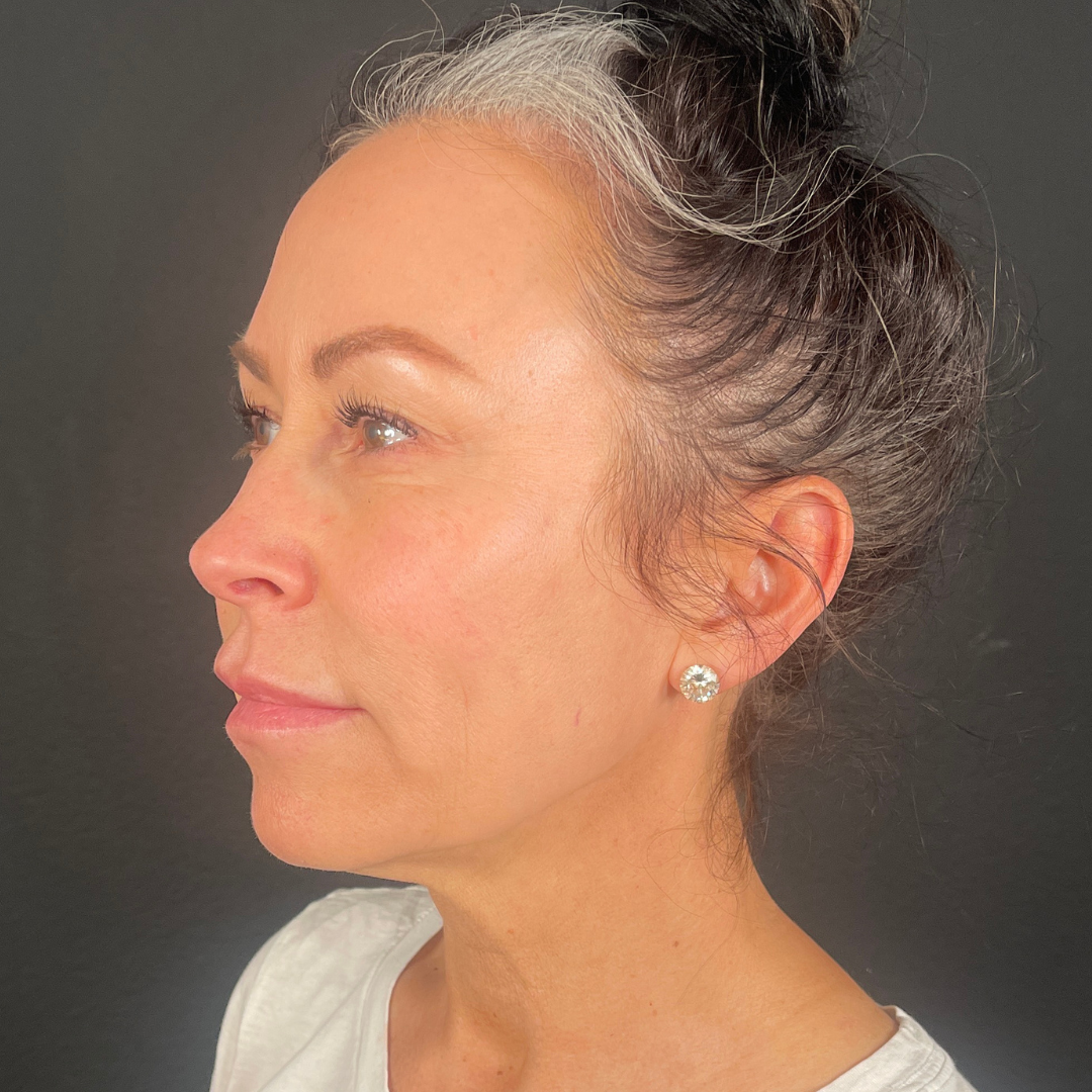 Case--7901 | After PDO Threads 2