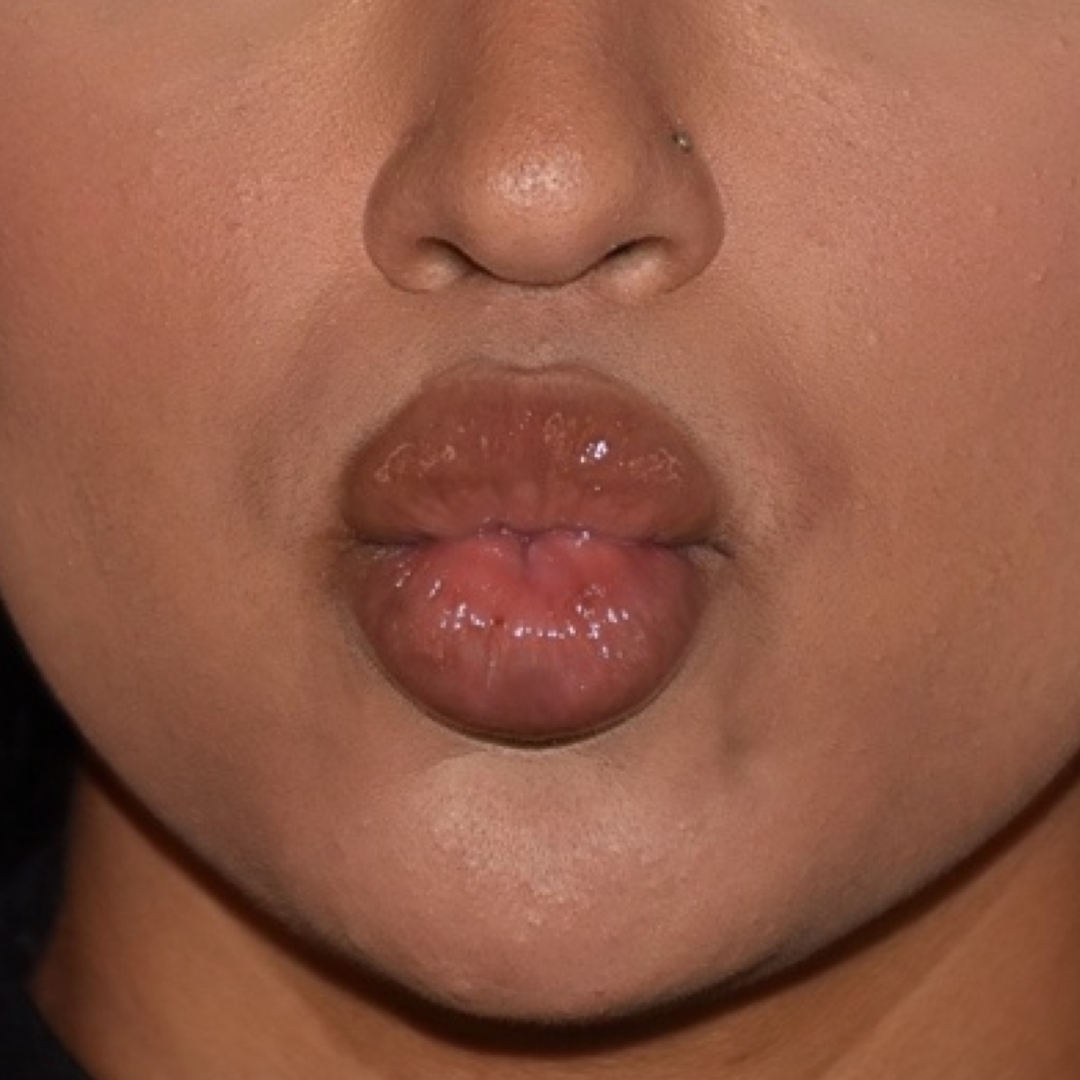Case--9574 | After Facial Fillers