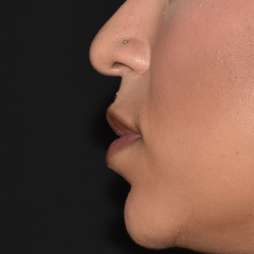 Case--9574 | Before Facial Fillers 2
