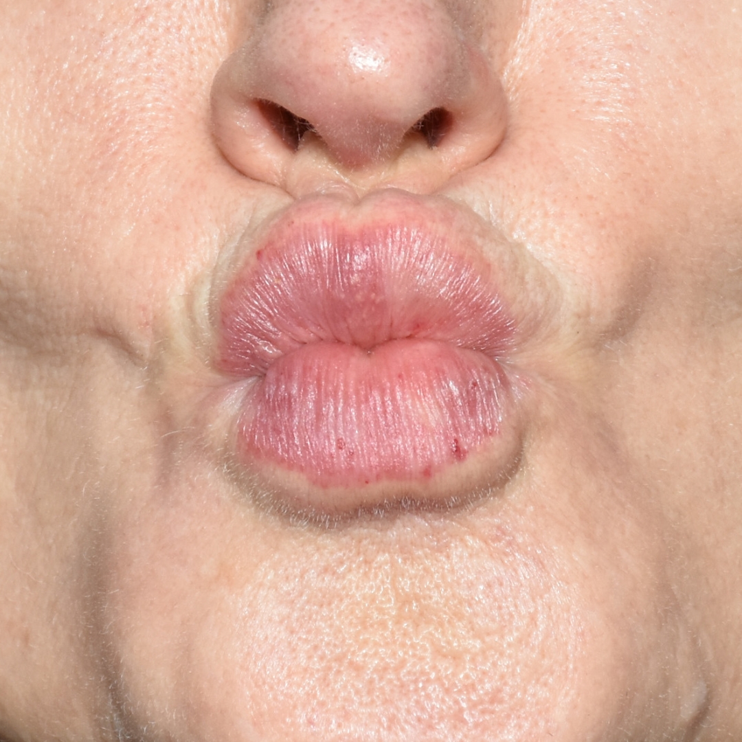 Case--7970 | After Facial Fillers 1