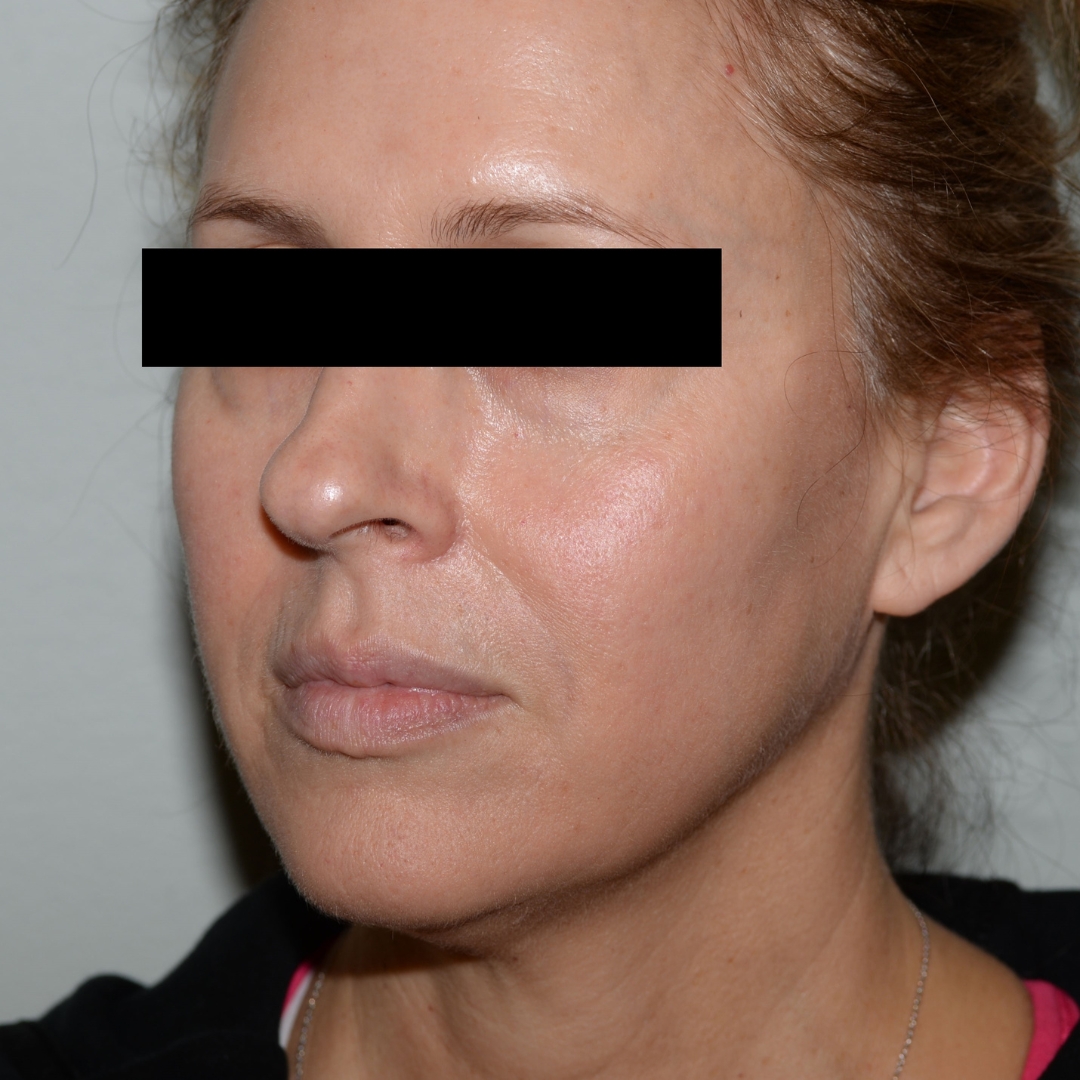 Case--2377 | After Facial Fillers 1