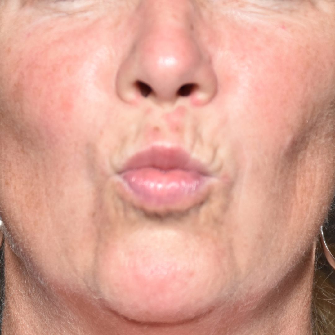 Case--4342 | After Facial Fillers 1