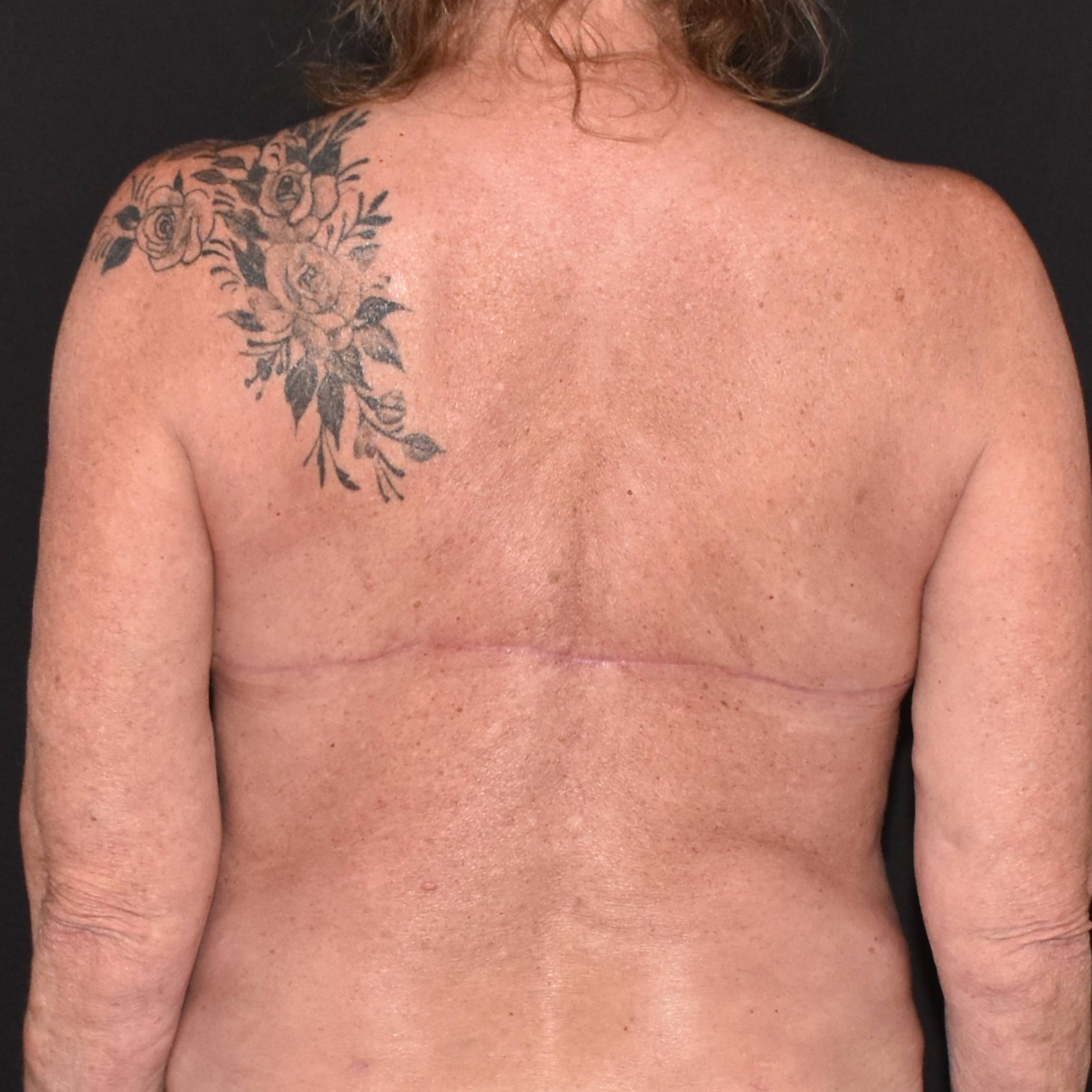 Case--7695 | After Backplasty