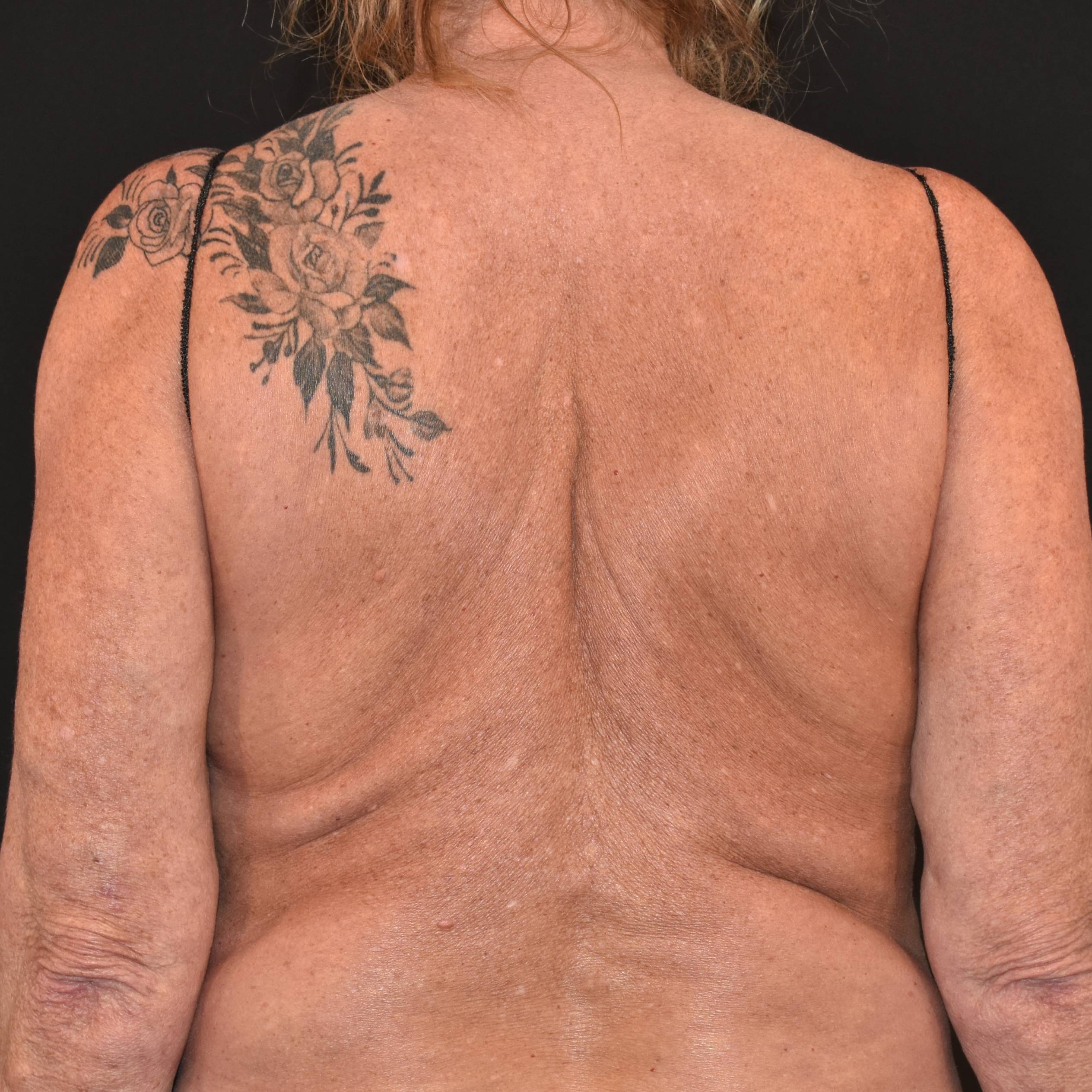 Case--7695 | Before Backplasty