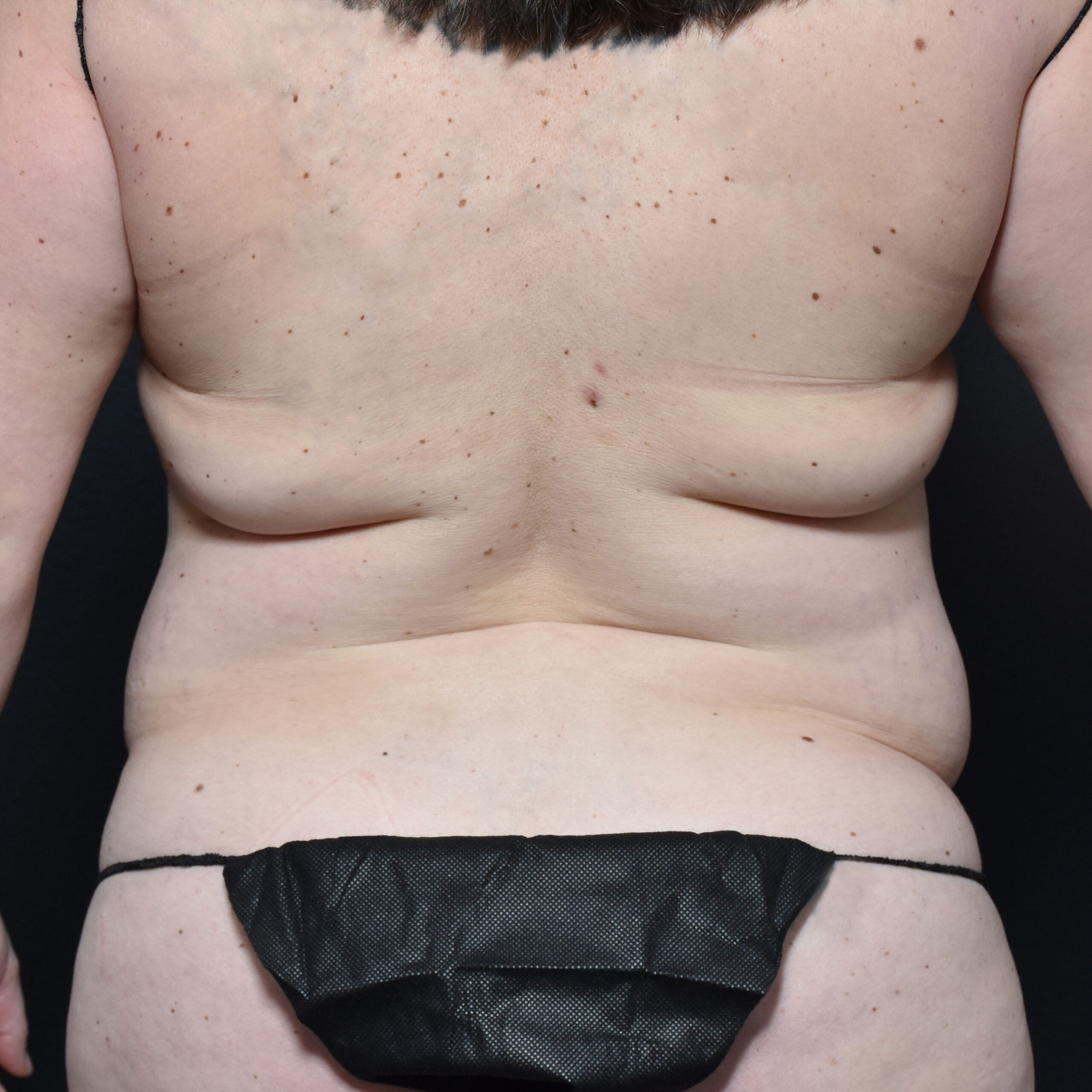 Case--2409 | Before Tummy Tuck 5